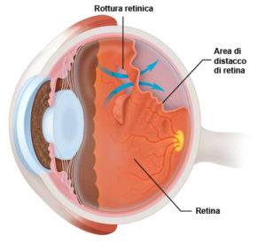 distacco retina con rottura