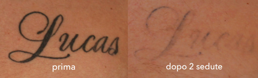 Rimozione tatuaggi (prima e dopo)